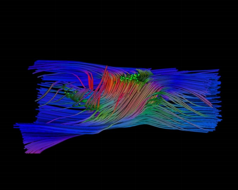 Spinal injuries: the recovery of motor skills thanks to nanomaterials-Carbon nanotube scaffold enables regenerated axons to cross the spinallesion gap (in red and green: MRI track fibre reconstruction after 6 months implantation)-