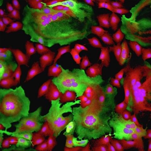 Un farmaco antiparassitario può bloccare il danno polmonare da Covid- 19-giacca-Possibili siti di mutazioni potenzialmente più aggressive sia sulla proteina umana ACE2 (azzurro) che sulla proteina Spike del SARS-CoV-2 (marrone) predette nello studio del MolBNL@UniTS