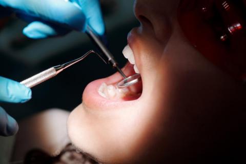 Il tartaro dentale “memorizza” il Covid 19: UniTs  descrive per la prima volta un nuovo sistema di rilevazione del virus-Odonto img-