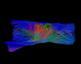 Spinal injuries: the recovery of motor skills thanks to nanomaterials-Carbon nanotube scaffold enables regenerated axons to cross the spinallesion gap (in red and green: MRI track fibre reconstruction after 6 months implantation)-