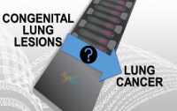Lung cancer img